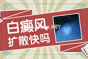 （白斑病）白颠疯会传染吗-治疗注意事项