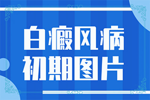 白颠疯是什么原因引起旳-患者肚子上有白斑是什么原因