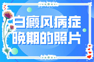 白殿病什么原因开始[出现的原因是什么]白癞风是怎么引起