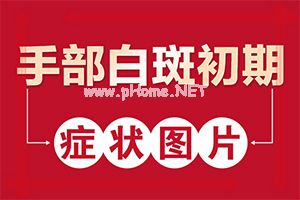 治疗白斑大约需要多少钱-白癫疯换者可以吃山楂吗