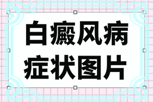 青少年患白癜风的原因有哪些-色素痣佳治疗方法