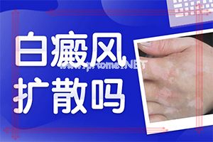 模糊白癜风做308要做几次稳定