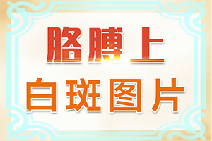 「良心看诊」治疗白癜风的土方「切勿拖延」白癜风治疗