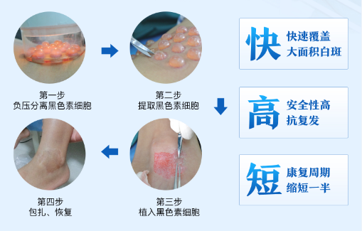 【白癜风外科手术治疗】小面积顽固性白斑-组织负压吸疱表皮移植术.png