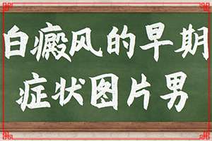 儿童白癞癜风最初症状,如何区分(刚发现的白斑)